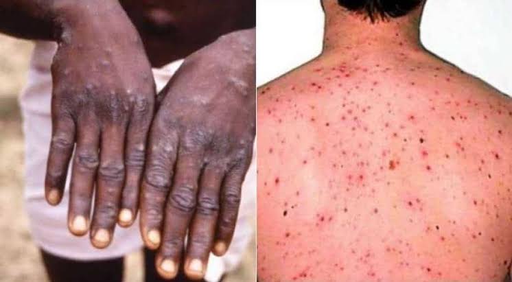  WHAT YOU NEED TO KNOW ABOUT THE MONKEY POX VIRUS