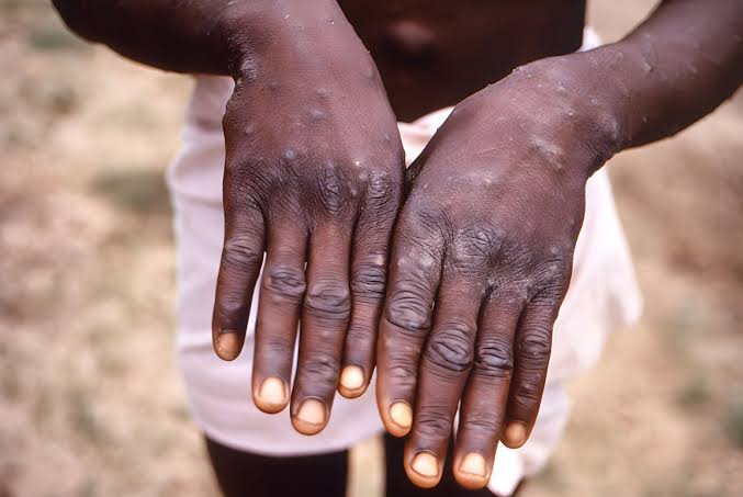 AFRICA RACES AGAINST TIME TO COMBAT MPOX OUTBREAK WITH VACCINES AND INNOVATIVE SOLUTIONS