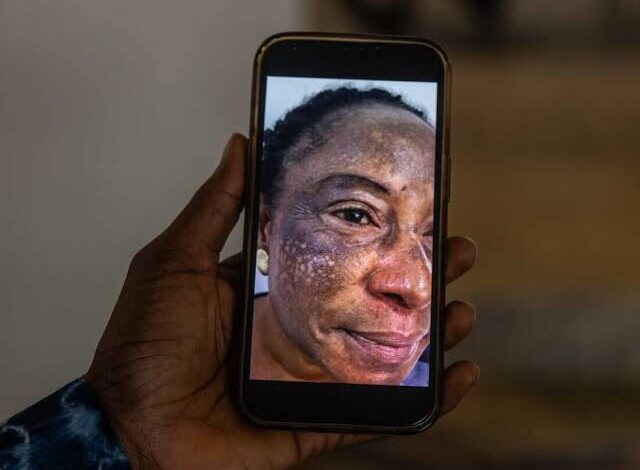  DEADLY OBSESSION: HOW SKIN-LIGHTENING CREAMS ARE CAUSING CANCER IN BLACK WOMEN