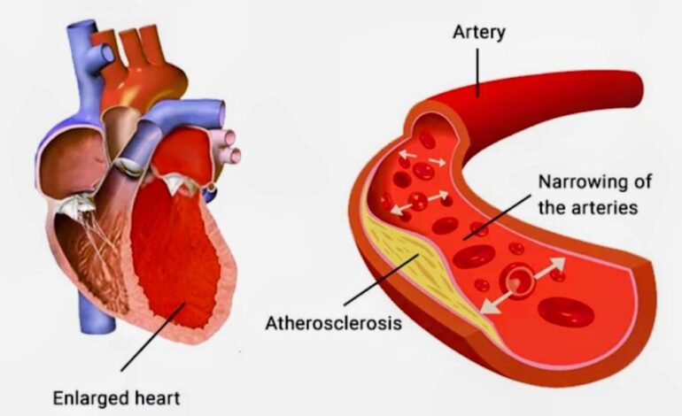 THE SILENT KILLER: HIGH BLOOD PRESSURE IS ON THE RISE